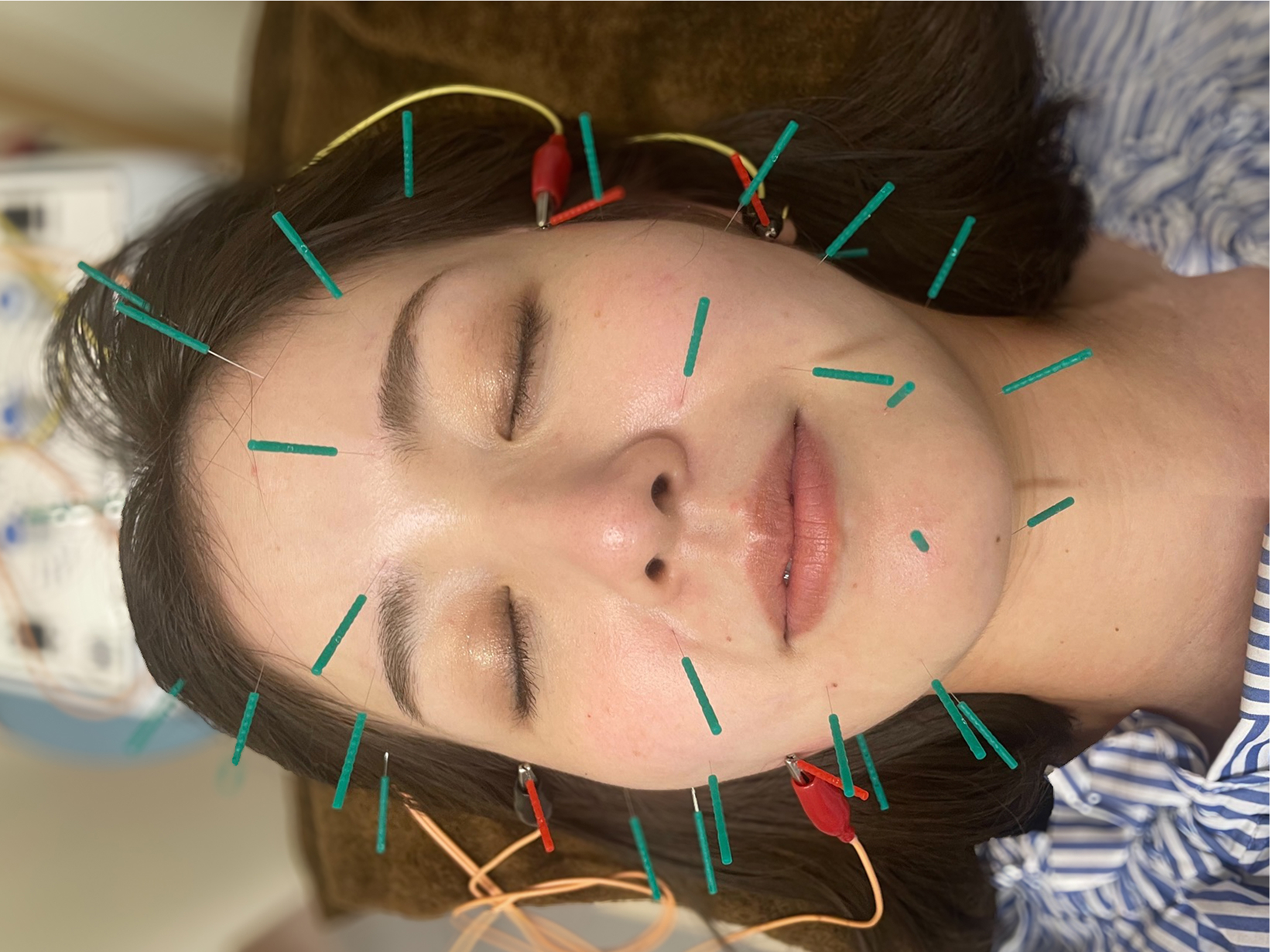 美容鍼コースの施術イメージ